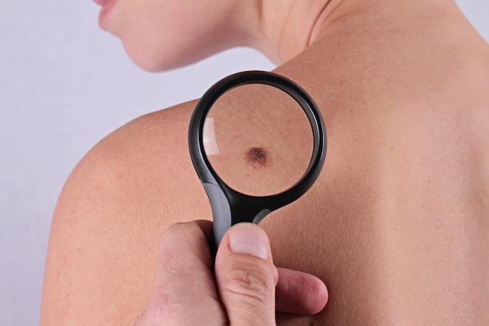 Semaine de dépistage gratuit du cancer de la peau : 80 000 nouveaux cas diagnostiqués chaque année