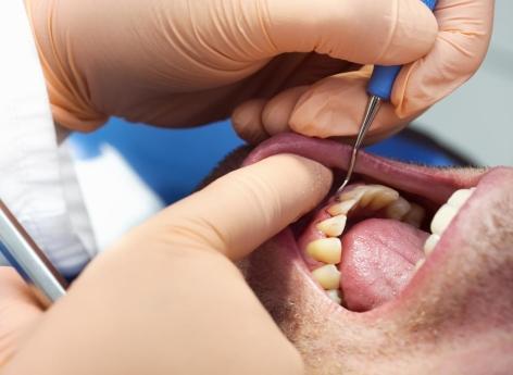Atrial fibrillation: beware of periodontitis