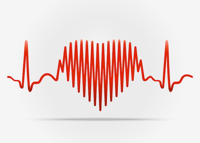 Fibrillation auriculaire : quand le cœur déraille !