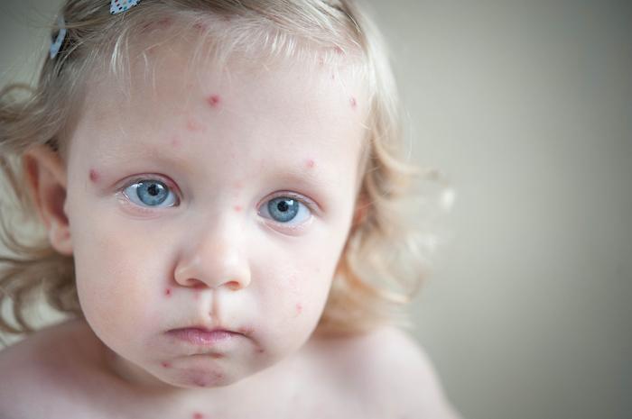 Epidémie de varicelle en Bretagne : quels risques pour les adultes contaminés ?