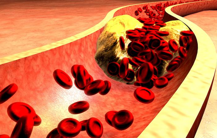 Hypercholestérolémie : traiter fortement le cholestérol ne suffit pas toujours