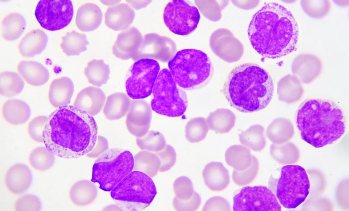 Traitements ciblés : comprendre leur impact sur les cellules de leucémie pour améliorer le traitement 