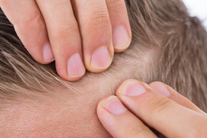Des scientifiques stimulent la repousse des cheveux sur une peau abîmée