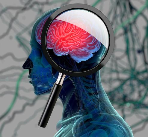 Le difficile combat des médicaments contre la maladie d'Alzheimer