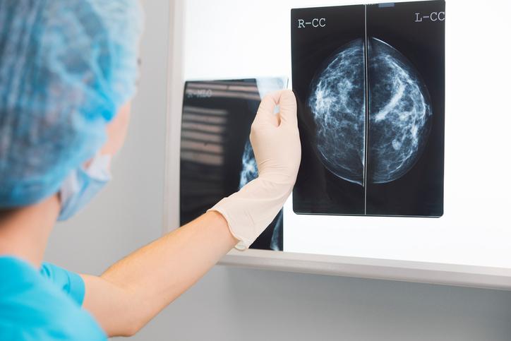 Cancer du sein : 99 femmes sur 100 sont toujours en vie après un diagnostic précoce