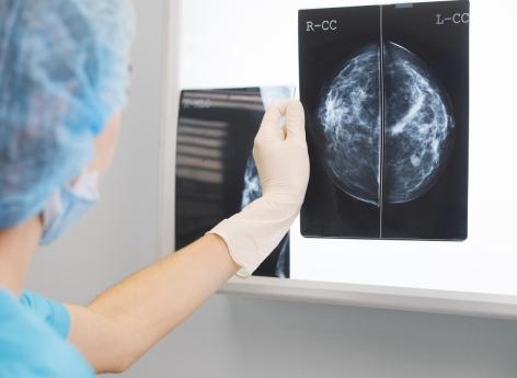 Cancer du sein : la glace peut éliminer une tumeur sans chirurgie 