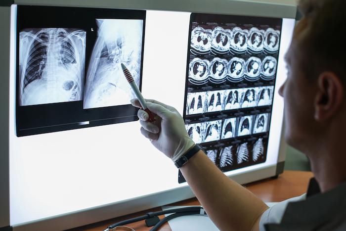 Cancer du poumon : les experts se mobilisent pour un dépistage massif