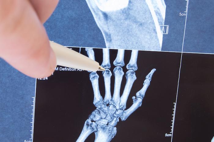Rhumatismes : parlez avec les chercheurs qui se battent contre les maladies articulaires et osseuses 