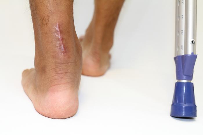 Rupture du tendon d’Achille : quand faut-il opérer ?