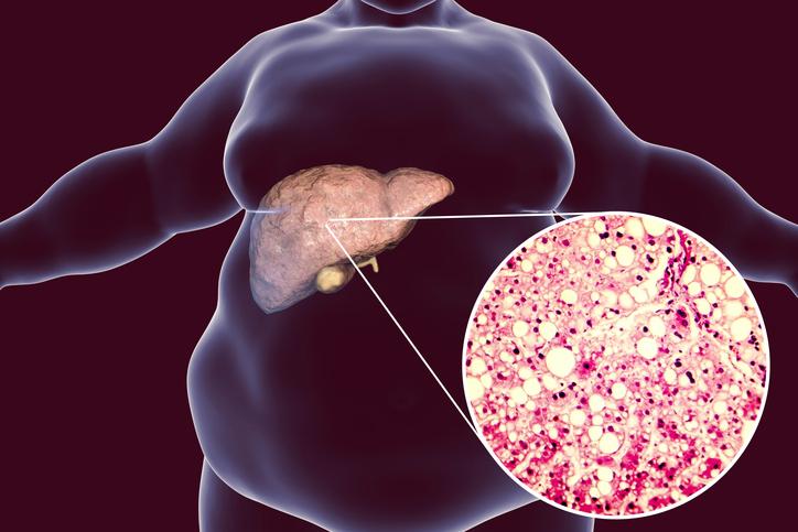 NASH: European researchers discover how to fight "fatty liver" disease