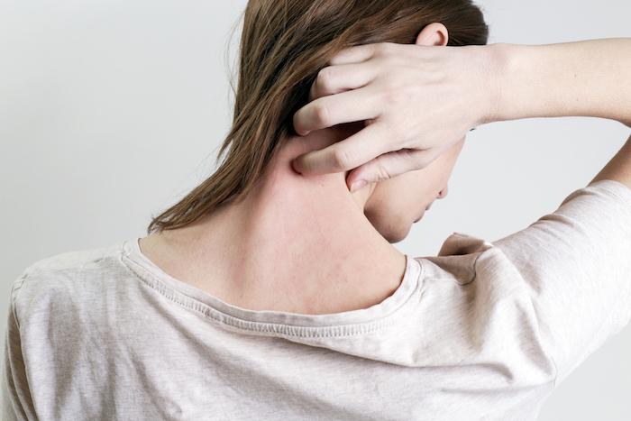 Psoriasis : une maladie de peau terriblement gênante