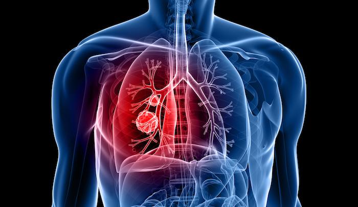 Cancer du poumon : allongement décisif de la survie si une thérapie ciblée est possible
