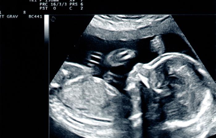 Interruption de grossesse ratée : le bébé est inopérable