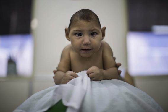 Zika : des bébés ont développé une microcéphalie après la naissance