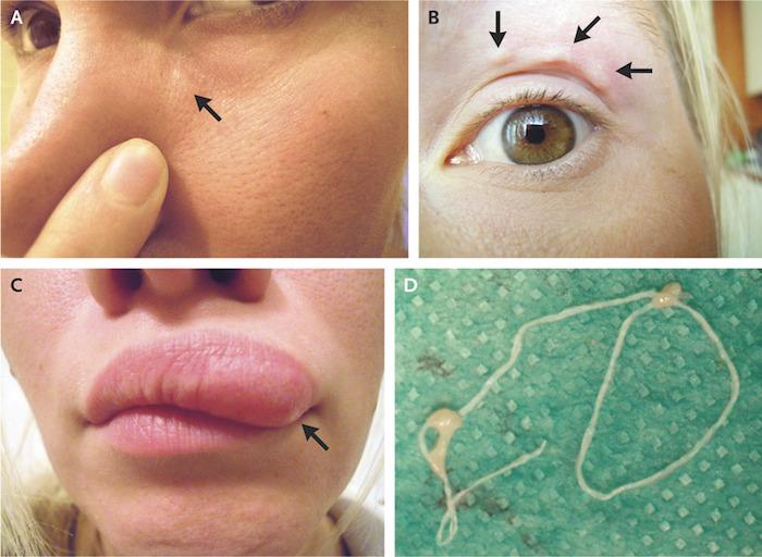 Un ver rampe sous la peau de son visage pendant deux semaines : voici le Dirofilaria repens