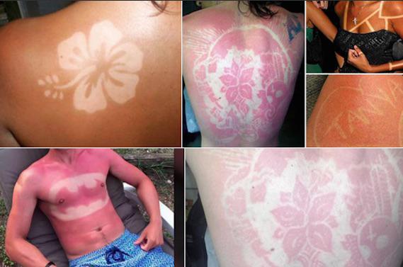 Sunburn art : un coup de soleil qui peut conduire au cancer de la peau
