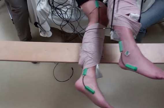 Lésions médullaires : 5 paraplégiques bougent à nouveau leurs jambes