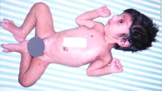 Inde : le bébé né avec 4 jambes opéré avec succès