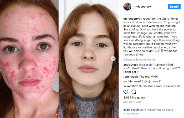 Instagram : un combat contre l’acné inspire des milliers d’ados