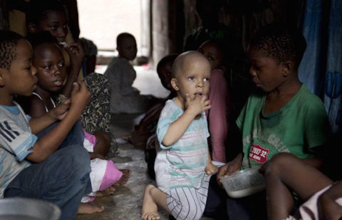 Mozambique : un jeune albinos massacré pour récupérer son cerveau 