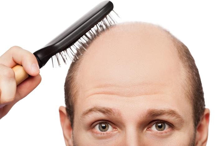 Calvitie : des chercheurs ont mis au point différentes techniques pour stimuler la repousse des cheveux