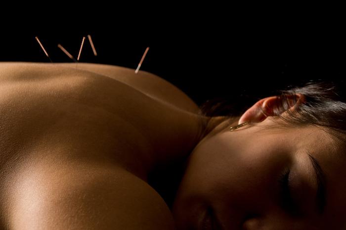 Le pouvoir de l'acupuncture contre la douleur et les allergies