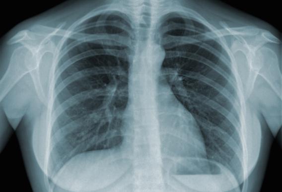 Poumon : fumer un paquet par jour engendre 150 mutations génétiques