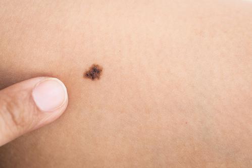 Cancer de la peau : les dermatologues proposent un dépistage gratuit en mai