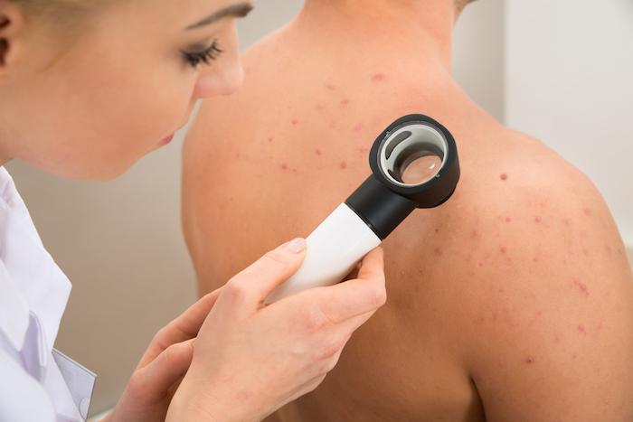 Cancers de la peau : les signes qui doivent alerter