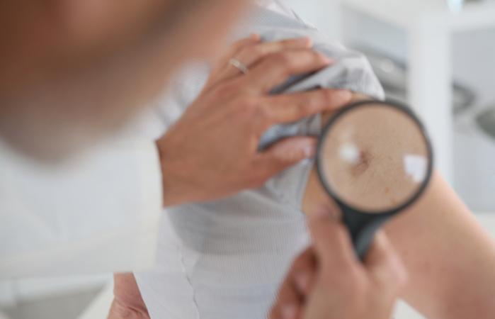 Cancer de la peau : 300 dermatologues s'ouvrent au public