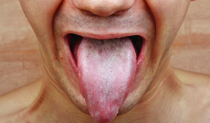 Les probiotiques ou les chewing-gums au xylitol n'ont aucun effet sur l’angine