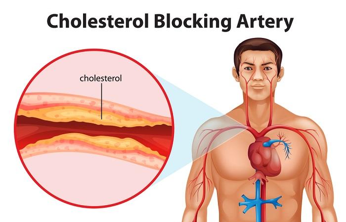 Cholestérol LDL, le principal annonciateur d’athérosclérose 