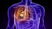 Une nouvelle immunothérapie prometteuse dans le cancer du poumon métastasé 