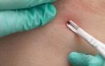 Tiques : quels sont les signes de la maladie de Lyme ?