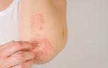 Biothérapies dans le psoriasis : peut-on réduire la posologie sans risque ?