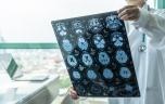 Alzheimer : un test permet de détecter la maladie 3,5 ans plus tôt 