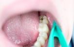 Et si les caries pouvaient bientôt disparaître sans plombage ?