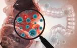 Cancer colorectal : certaines bactéries du microbiote peuvent entraver la chimiothérapie