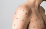Mpox : ce que l’on sait sur le premier cas détecté à la Réunion
