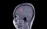 Progestatifs : une étude confirme un lien avec un risque accru de tumeurs au cerveau