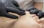 SMOP et électrolyse contre l'hirsutisme : 