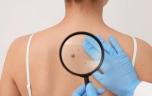 Grain de beauté et mélanome : pourquoi le soleil n’est pas le seul risque