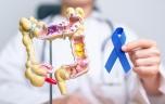 Cancer colorectal : dans quels départements se fait-on le plus dépister ? 