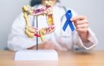 Cancer colorectal : comment un test de dépistage peut tout changer