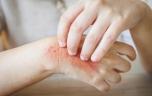 Eczéma : le traitement le plus répandu ne tiendrait pas ses promesses