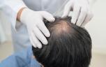 Analogues du GLP-1 : un effet inattendu sur les cheveux ?