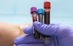 Endométriose : une analyse de sang pour éviter l'errance diagnostique