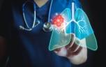 Bientôt un médicament pour prévenir le cancer du poumon ?