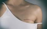 Cancer du sein : cette carence augmente les douleurs post-chirurgicales