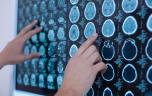 Certaines tumeurs cérébrales pourraient être liées à un traumatisme crânien